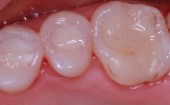 Удаление непригодных реставраций и восстановление простой анатомической формы зубов