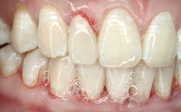 Реставрация зуба (простой композитный винир)