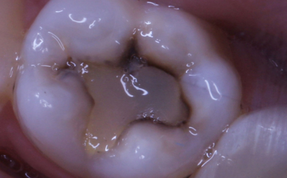 Лечение глубокого кариеса и простое восстановление анатомической формы зуба