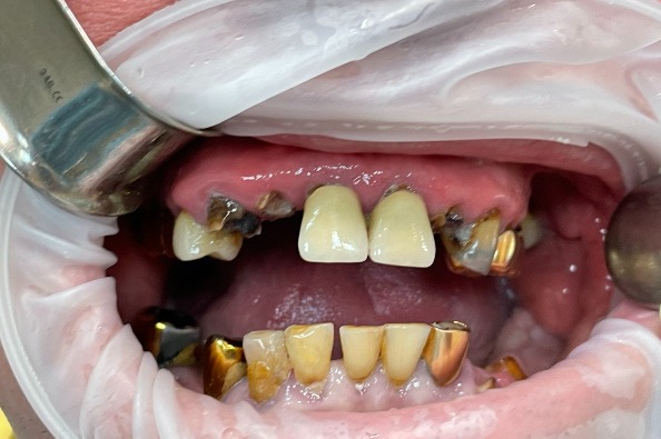 Имплантация all-on-4 верхняя и нижняя челюсть