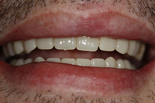 Имплантация на 4-х с удалением зубов