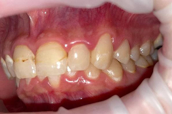 Реставрация зубов 2.2;2.3;2.4