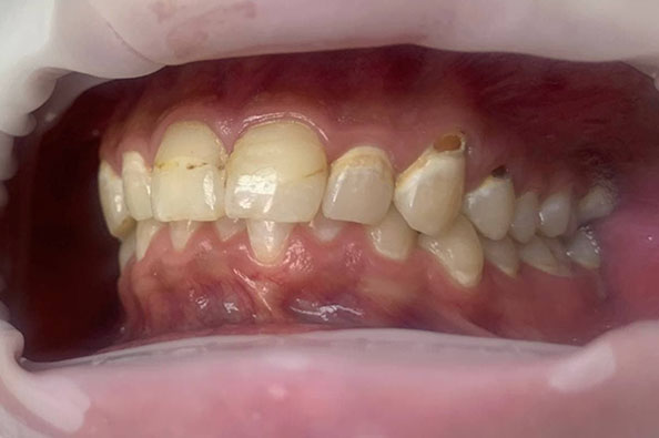 Реставрация зубов 2.2;2.3;2.4