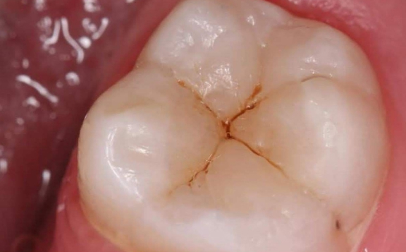 Лечение глубокого кариеса с последующей художественной реставрацией зуба